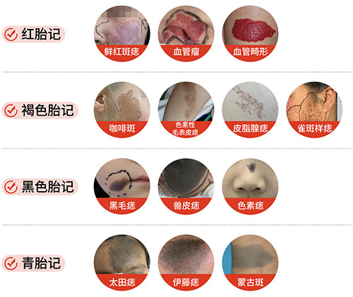胎记分为哪几种？各类胎记有什么不一样？