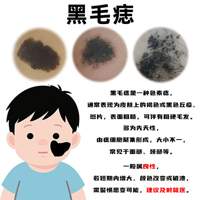 南京哪里可以看黑毛痣？黑毛痣是什么问题？