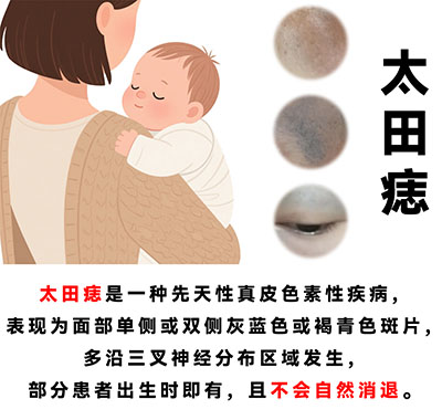 太田痣有什么发病规律？南京治疗太田痣哪里专业？